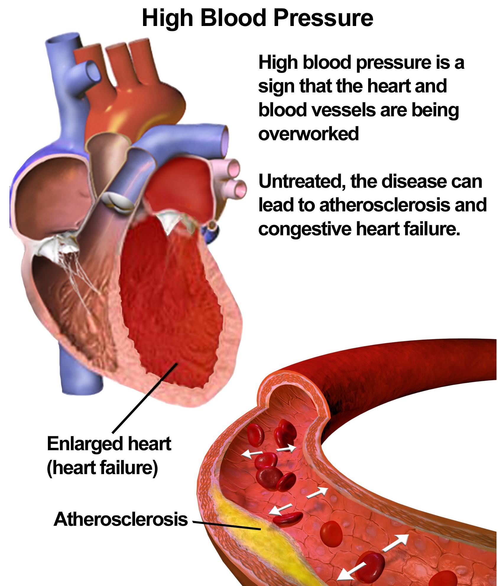 High Blood Pressure